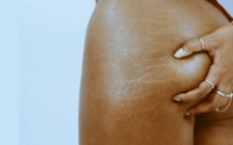 Quelques soins simples et naturels pour se débarrasser des vergetures