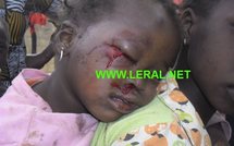 [Exclusivé Photo ] Les forces de l’ordre explosent l’œil d’une fillette de 2 ans