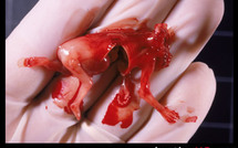 Des avortements sélectifs font scandale au Royaume-Uni