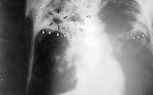 Sénégal-réduction drastique du nombre de décès dû à la tuberculose : Plan Sénégal en appoint aux structures sanitaires du pays