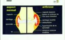 [Video] Découverte: Deux plantes qui soignent respectivement le cancer et l’arthrose