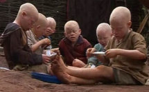 Plainte: Les Albinos veulent traduire en justice les criminels 