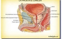Journée de consultations gratuites sur le cancer de la prostate