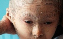 Un « enfant-poisson » couvert d’écailles de la tête aux pieds