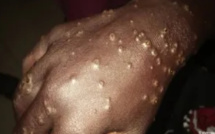 Maladie de la peau, un nouveau cas détecté à Thiaroye-sur-mer: Vers une deuxième vague ?