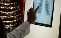 Tuberculose: Diourbel est la deuxième région la plus touchée du Sénégal
