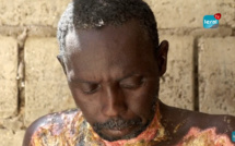 Guédiawaye / Grièvement brûlé, Babacar se meurt à petit feu (Ames sensibles s'abstenir)