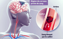 Prise en charge de l’Avc au Sénégal : La forte fréquence de décès s’explique par le manque de structures