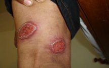 Le parasite meurtrier qui menace l'Etat islamique