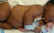 La drépanocytose : Une maladie génétique du sang