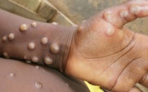 Mpox : L'OMS prolonge son niveau d'alerte maximale