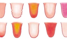 8 problèmes de santé révélés par votre langue