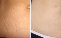 Voici comment se débarrasser des vergetures naturellement