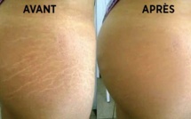 Voici comment se débarrasser naturellement des vergetures en 6 semaines !