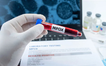 Cas de variole du singe détecté au Sénégal :  Le ministère confirme un cas de Mpox chez un étranger à Dakar