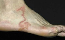 Il pense que c’est juste une varice. Mais lorsque le docteur voit son pied? Horrible!