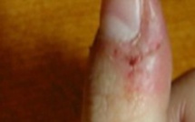Si vous rongez la peau autour de vos ongles, il faut arrêter. Voici pourquoi.