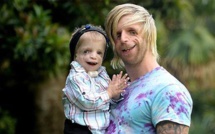 Il va en Australie pour rencontrer un petit garçon au visage déformé. Le message qu’il fait passer est rempli d’espoir.
