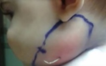 Choc : des médecins retirent une plume de la gorge de ce bébé !