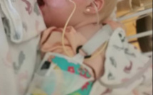 Un bébé avec une langue énorme peut enfin sourire normalement