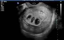 Naissance miraculeuse d'un bébé condamné à mourir dans l'utérus